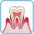 軽度歯周病